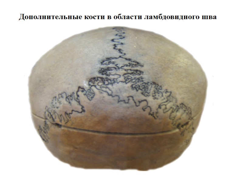 Дополнительные кости в области ламбдовидного шва